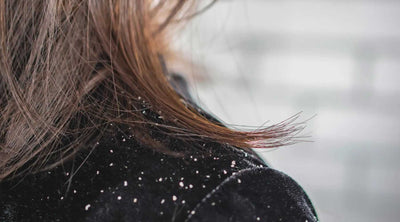 كيفية علاج قشرة الشعر والتخلص منها نهائياً – أسباب وعلاجات