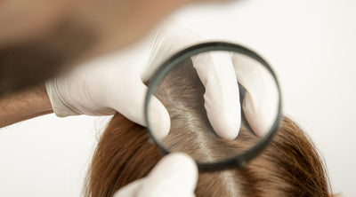 ما هي اكزيما الشعر ؟ أسبابها و كيف يمكن علاجها وتفادي تفاقمها