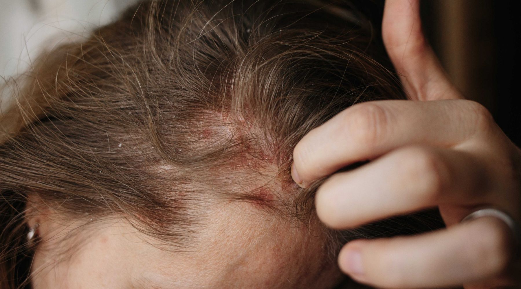 أعراض اصابتك بـ إلتهاب فروة الرأس، وهل هي سبب تساقط الشعر؟!