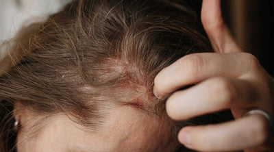 التهاب فروة الرأس، كيف تعرف إذا كنت مصاباً بإلتهاب فروة الرأس، وهل هي سبب لتساقط شعرك؟! تعرف على أسبابها وأعراضها وطرق علاجها!