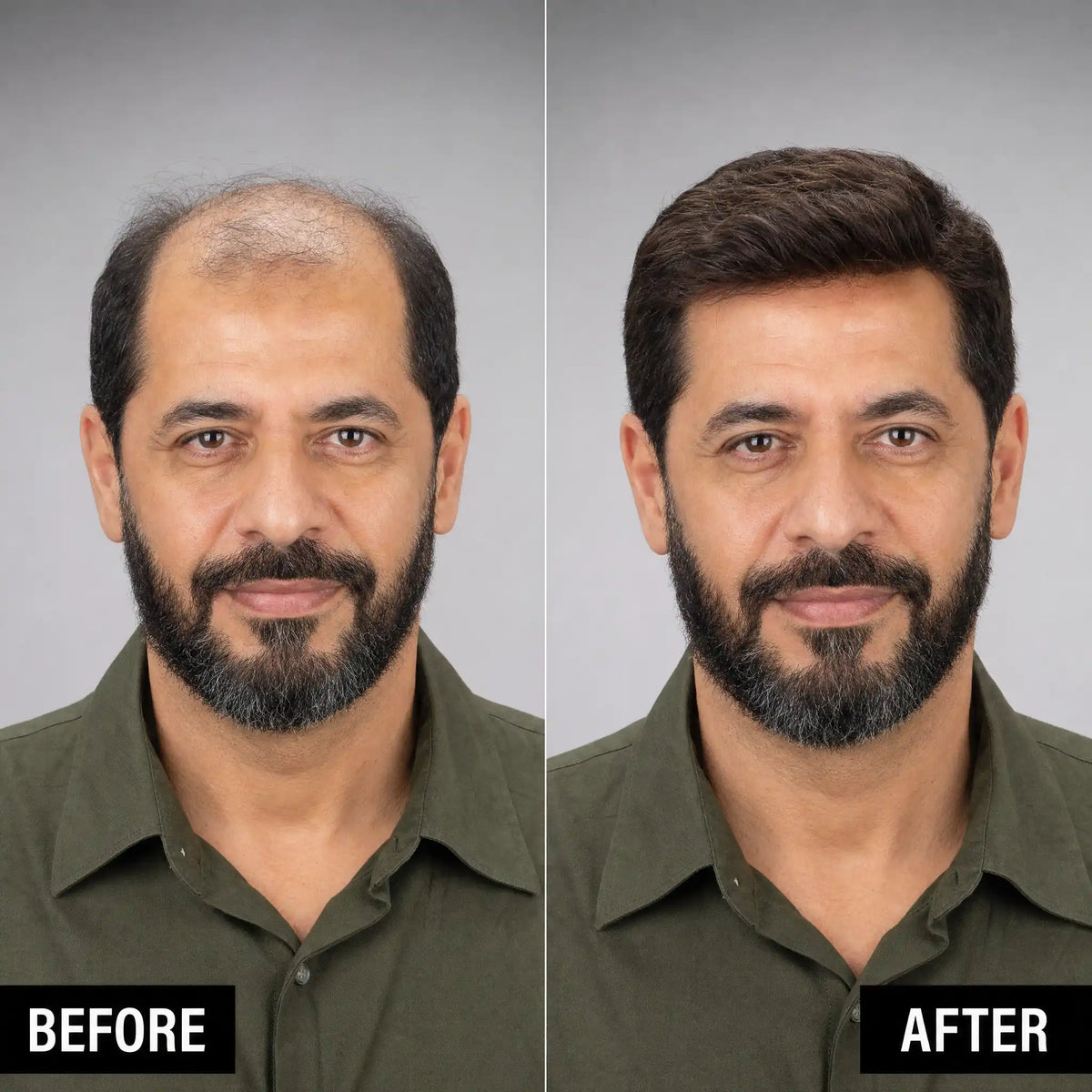 Men’s Wig Hair with French Lace in Body with Skin