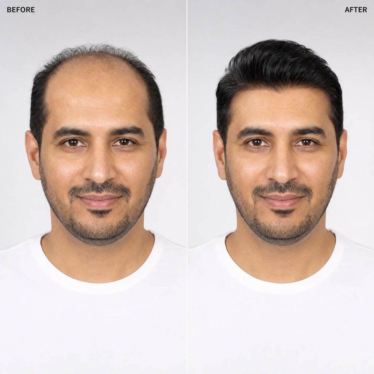 Men’s Wig Hair with French Lace in Body with Skin