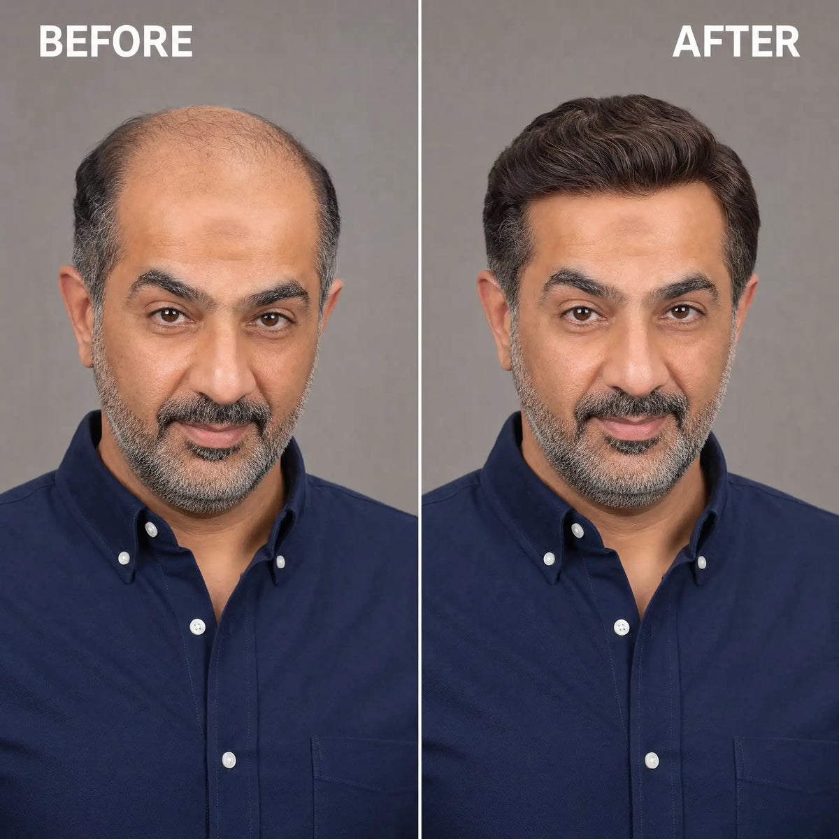 Men’s Wig Hair with French Lace in Body with Skin